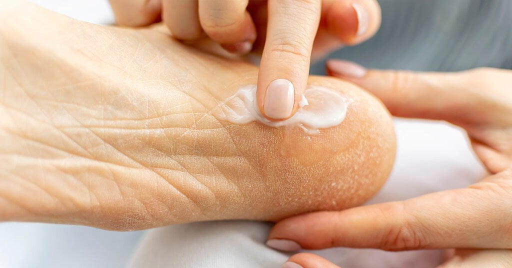 Hielkloven behandelen – hydrateren en eelt verwijderen