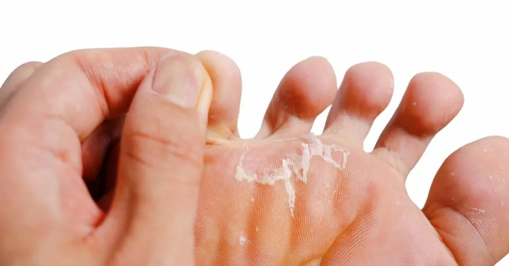 Voeten en schoenen droog houden bij voetschimmel